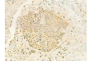 ABIN6264758 and ABIN6279799 at 1/100 staining human esophageal carcinoma by IHC-P. (RIOK1 Antikörper  (C-Term))