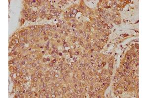 IHC image of ABIN7144729 diluted at 1:250 and staining in paraffin-embedded human liver cancer performed on a Leica BondTM system. (GOT1 Antikörper  (AA 2-411))