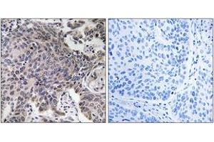 Immunohistochemistry analysis of paraffin-embedded human lung carcinoma tissue, using MRPL54 Antibody.