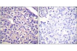 Immunohistochemistry analysis of paraffin-embedded human breast carcinoma tissue, using MYPT1 (Ab-696) Antibody. (PPP1R12A Antikörper  (AA 661-710))