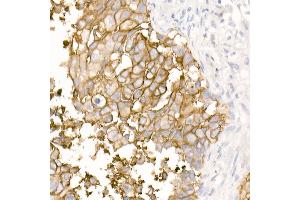 Immunohistochemistry of paraffin-embedded Human lung squamous carcinoma tissue using TROP-2 antibody (ABIN7271103) at dilution of 1:2700 (40x lens). (TACSTD2 Antikörper)