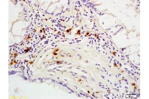 Formalin-fixed and paraffin embedded human colon carcinoma labeled with Rabbit Anti phospho-p53BP1(Ser25/29) Polyclonal Antibody, Unconjugated (ABIN682993) at 1:200 followed by conjugation to the secondary antibody and DAB staining