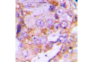 Immunohistochemical analysis of 4EBP1 staining in human lung cancer formalin fixed paraffin embedded tissue section. (eIF4EBP1 Antikörper  (N-Term))