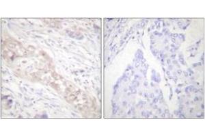 Immunohistochemistry analysis of paraffin-embedded human breast carcinoma, using Smad2 (Phospho-Ser467) Antibody. (SMAD2 Antikörper  (pSer467))