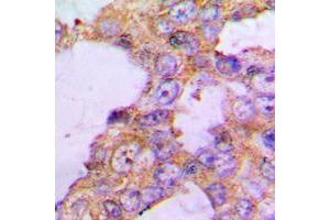 Immunohistochemical analysis of COX5B staining in human lung cancer formalin fixed paraffin embedded tissue section.
