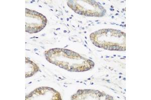 Immunohistochemistry of paraffin-embedded human gastric using NEDD4 antibody (ABIN1681009, ABIN3015207, ABIN3015208 and ABIN6213883) at dilution of 1:200 (40x lens).