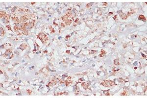 Immunohistochemistry of paraffin-embedded Human breast cancer using Desmoplakin Polyclonal Antibody at dilution of 1:100 (40x lens). (Desmoplakin Antikörper)