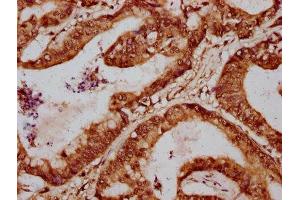 IHC image of ABIN7155055 diluted at 1:700 and staining in paraffin-embedded human colon cancer performed on a Leica BondTM system.