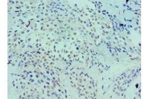 Immunohistochemistry of paraffin-embedded human breast cancer using ABIN7158577 at dilution of 1:100 (LRP6 Antikörper  (AA 20-150))