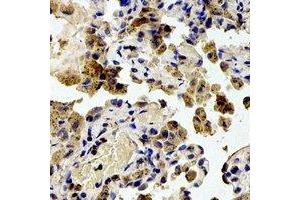 Immunohistochemical analysis of RPS20 staining in human lung cancer formalin fixed paraffin embedded tissue section.