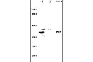 Formalin-fixed and paraffin embedded human lung carcinoma labeled with Anti-GPR15 Polyclonal Antibody, Unconjugated (ABIN702835) at 1:200 followed by conjugation to the secondary antibody and DAB staining. (GPR15 Antikörper  (AA 51-150))