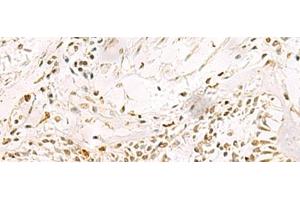 Immunohistochemistry of paraffin-embedded Human lung cancer tissue using PDS5A Polyclonal Antibody at dilution of 1:90(x200) (PDS5A Antikörper)