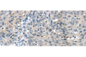 Immunohistochemistry of paraffin-embedded Human breast cancer using GLP2R Polyclonal Antibody at dilution of 1/30 (GLP2R Antikörper)