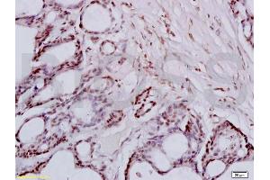 Formalin-fixed and paraffin embedded human colon carcinoma tissue labeled with Anti-FRA2/FOSL2 Polyclonal Antibody, Unconjugated (ABIN673104) at 1:200 followed by conjugation to the secondary antibody and DAB staining (FOSL2 Antikörper  (AA 231-326))