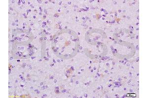 Formalin-fixed and human glioma tissue labeled with Anti-MAP1A Polyclonal Antibody (ABIN735308), Unconjugated at 1:200 followed by conjugation to the secondary antibody and DAB staining (MAP1A Antikörper  (AA 2651-2750))