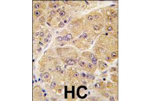 Formalin-fixed and paraffin-embedded human hepatocarcinoma tissue reacted with SOST antibody , which was peroxidase-conjugated to the secondary antibody, followed by DAB staining. (Sclerostin Antikörper  (AA 134-163))