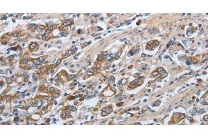 Immunohistochemistry of paraffin-embedded Human gasrtic cancer tissue using SLC34A2 Polyclonal Antibody at dilution of 1:50 (SLC34A2 Antikörper)
