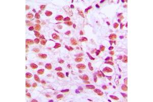 Immunohistochemical analysis of ELK1 (pS389) staining in human breast cancer formalin fixed paraffin embedded tissue section. (ELK1 Antikörper  (C-Term, pSer389))
