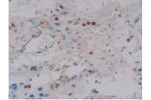 IHC-P analysis of Human Breast Cancer Tissue, with DAB staining. (DEFA4 Antikörper  (AA 23-97))