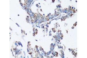 Immunohistochemistry of paraffin-embedded Human gastric cancer using SRC Polyclonal Antibody at dilution of 1:100 (40x lens). (Src Antikörper)