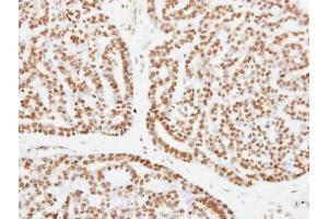 IHC-P Image Immunohistochemical analysis of paraffin-embedded human breast cancer, using XPC, antibody at 1:250 dilution.