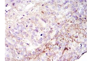Immunohistochemical analysis of paraffin-embedded cervices tumour using FAK mouse mAb with DAB staining (FAK Antikörper)