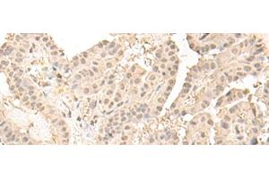 Immunohistochemistry of paraffin-embedded Human thyroid cancer tissue using ZGPAT Polyclonal Antibody at dilution of 1:35(x200) (ZGPAT Antikörper)