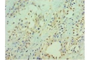 Immunohistochemistry of paraffin-embedded human breast cancer using ABIN7156537 at dilution of 1:100 (ICAM2 Antikörper  (AA 25-223))