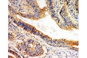 IHC-P: SLC1A4 antibody testing of human intestine cancer tissue (SLC1A4 Antikörper  (C-Term))