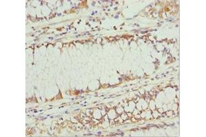 Immunohistochemistry of paraffin-embedded human colon cancer using ABIN7163636 at dilution of 1:100 (PLEKHA1 Antikörper  (AA 285-404))