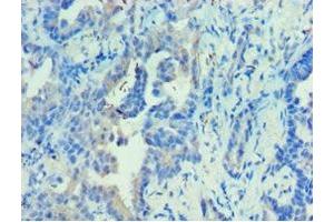 Immunohistochemistry of paraffin-embedded human lung cancer using ABIN7142680 at dilution of 1:100 (PRKAB2 Antikörper  (AA 1-272))