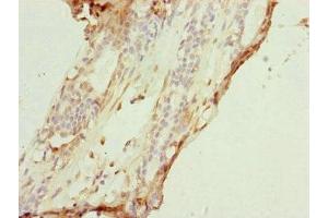Immunohistochemistry of paraffin-embedded human breast cancer using ABIN7149183 at dilution of 1:100