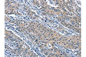 The image on the left is immunohistochemistry of paraffin-embedded Human gastric cancer tissue using ABIN7130004(KLF7 Antibody) at dilution 1/60, on the right is treated with fusion protein.