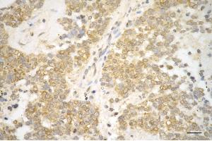 Immunohistochemistry was performed on paraffin-embedded human breast carcinoma using sorting nexin 1 antibody (ABIN7800408), 1:200).