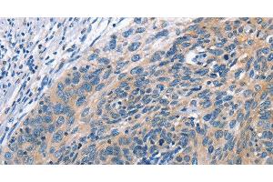 Immunohistochemistry of paraffin-embedded Human cervical cancer tissue using CUL7 Polyclonal Antibody at dilution 1:50 (Cullin 7 Antikörper)