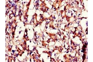 Immunohistochemistry of paraffin-embedded human gastric cancer using ABIN7159104 at dilution of 1:100 (MED12 Antikörper  (AA 1742-2011))