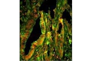 Immunofluorescence analysis of CZA1 Antibody (N-term) with paraffin-embedded human prostate carcinoma tissue. (CAPZA1 Antikörper  (N-Term))