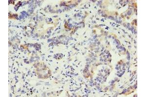Immunohistochemistry of paraffin-embedded human lung cancer using ABIN7157372 at dilution of 1:100