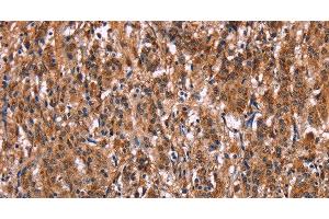 Immunohistochemistry of paraffin-embedded Human gasrtic cancer tissue using LILRB1 Polyclonal Antibody at dilution 1:50 (LILRB1 Antikörper)