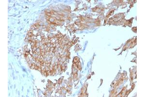 Formalin-fixed, paraffin-embedded human Urothelial Carcinoma stained with Uroplakin 1B Mouse Monoclonal Antibody (UPK1B/3102). (Uroplakin 1B Antikörper  (AA 109-229))