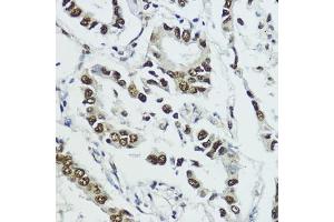Immunohistochemistry of paraffin-embedded human lung cancer using Phospho-Histone H3-T11 antibody (ABIN3023615, ABIN3023616, ABIN3023617 and ABIN6225469) at dilution of 1:100 (40x lens). (Histone 3 Antikörper  (pThr11))