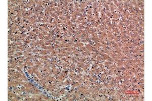 Immunohistochemical analysis of paraffin-embedded human-liver-cancer, antibody was diluted at 1:200 (Chordin Antikörper  (AA 905-954))