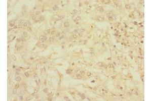 Immunohistochemistry of paraffin-embedded human pancreatic cancer using ABIN7174780 at dilution of 1:100 (C1ORF127 Antikörper  (AA 401-648))