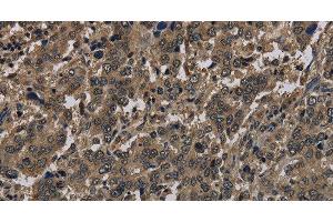 Immunohistochemistry of paraffin-embedded Human liver cancer using Histone H4 Polyclonal Antibody at dilution of 1:30 (Histone H4 Antikörper)