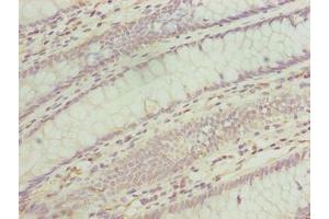 Immunohistochemistry of paraffin-embedded human colon cancer using ABIN7173167 at dilution of 1:100 (TMEM243 Antikörper  (AA 1-31))