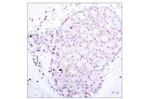 Immunohistochemical analysis of paraffin-embedded human breast carcinoma, using NF-κB p105/p50 (Ab-907) antibody (E021019). (NFKB1 Antikörper)