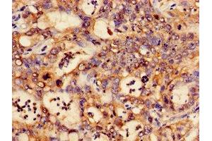Immunohistochemistry of paraffin-embedded human liver cancer using ABIN7146988 at dilution of 1:100 (CTNND1 Antikörper  (AA 482-605))