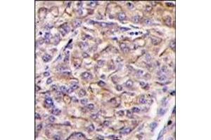 Formalin-fixed and paraffin-embedded human hepatocarcinoma tissue reacted with TAOK3 antibody (C-term), which was peroxidase-conjugated to the secondary antibody, followed by DAB staining. (TAO Kinase 3 Antikörper  (C-Term))