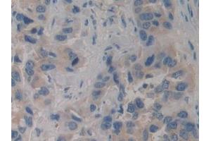 Detection of PIK3C3 in Human Breast cancer Tissue using Polyclonal Antibody to Phosphoinositide-3-Kinase Class 3 (PIK3C3) (PIK3C3 Antikörper  (AA 631-885))