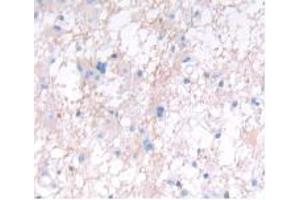 DAB staining on IHC-P; Samples: Human Glioma Tissue. (IFNA5 Antikörper  (AA 22-189))